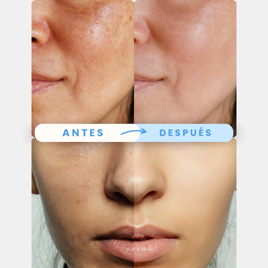 Masajeador Anti Celulitis - Combate la Flacidez y Celulitis