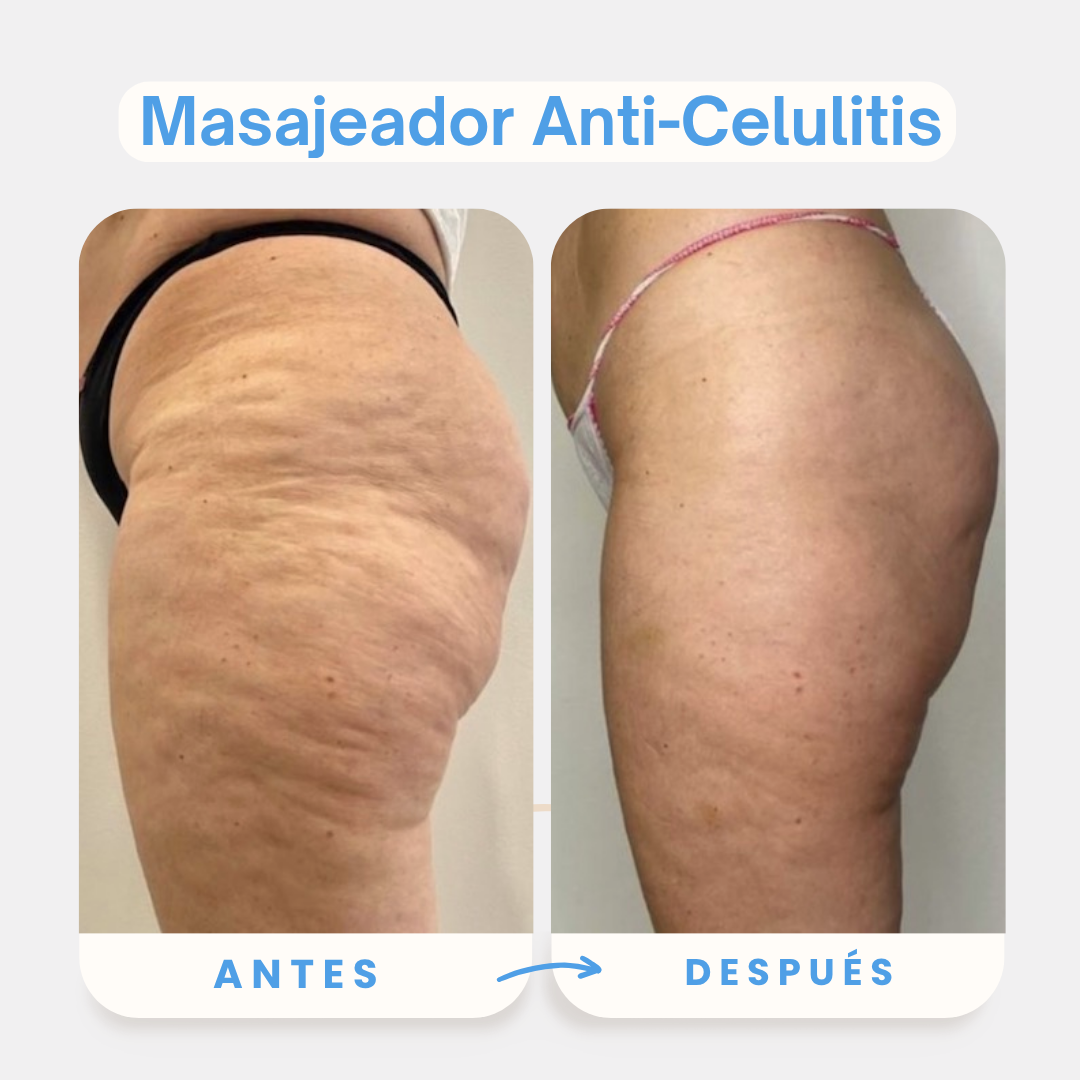 Masajeador Anti Celulitis + Masajeador Facial 3 en 1